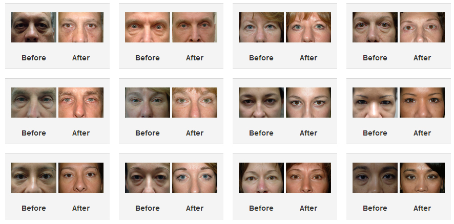 Blepharoplasty (Eye Lid Surgery) Before After Photo Northern Virginia