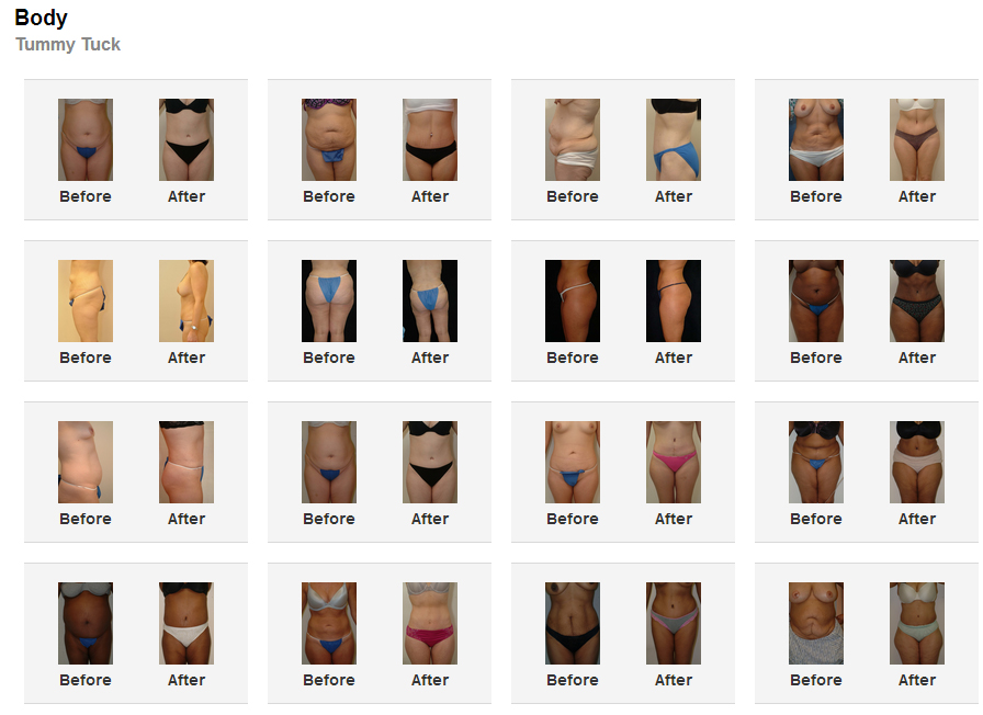 tummy tuck surgery before and after photos
